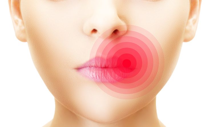 opryszczka na ustach leczenie