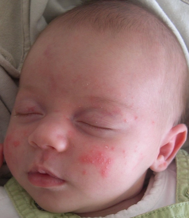 atopowe zapalenie skóry u niemowląt zmiany na skórze